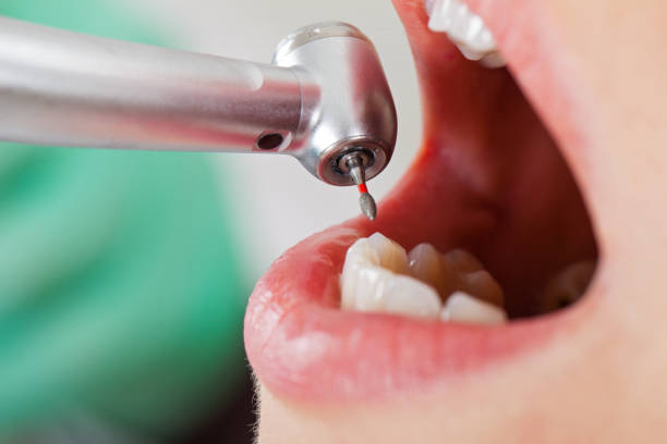 Best Emergency Wisdom Teeth Removal in Clarksville, TX